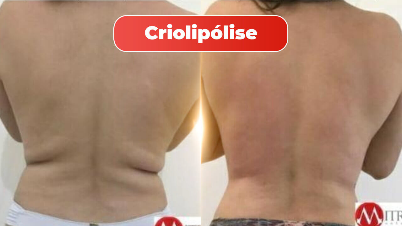 criolipolise-mitras-antes-e-depois-1-1.jpg