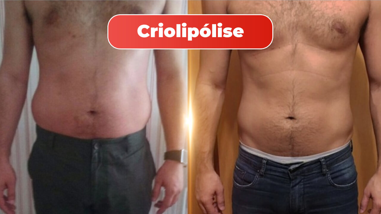 criolipolise-mitras-estetica-1-2.jpg