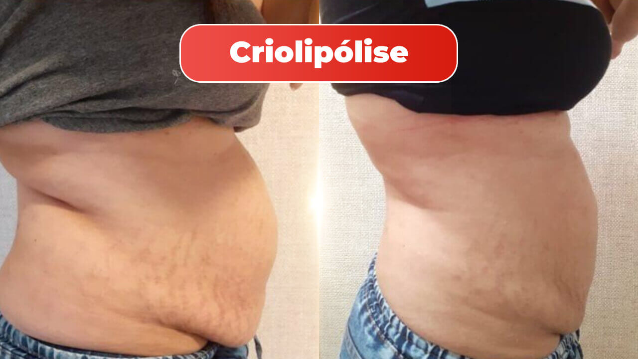 criolipolise-mitras-estetica-2-1.jpg