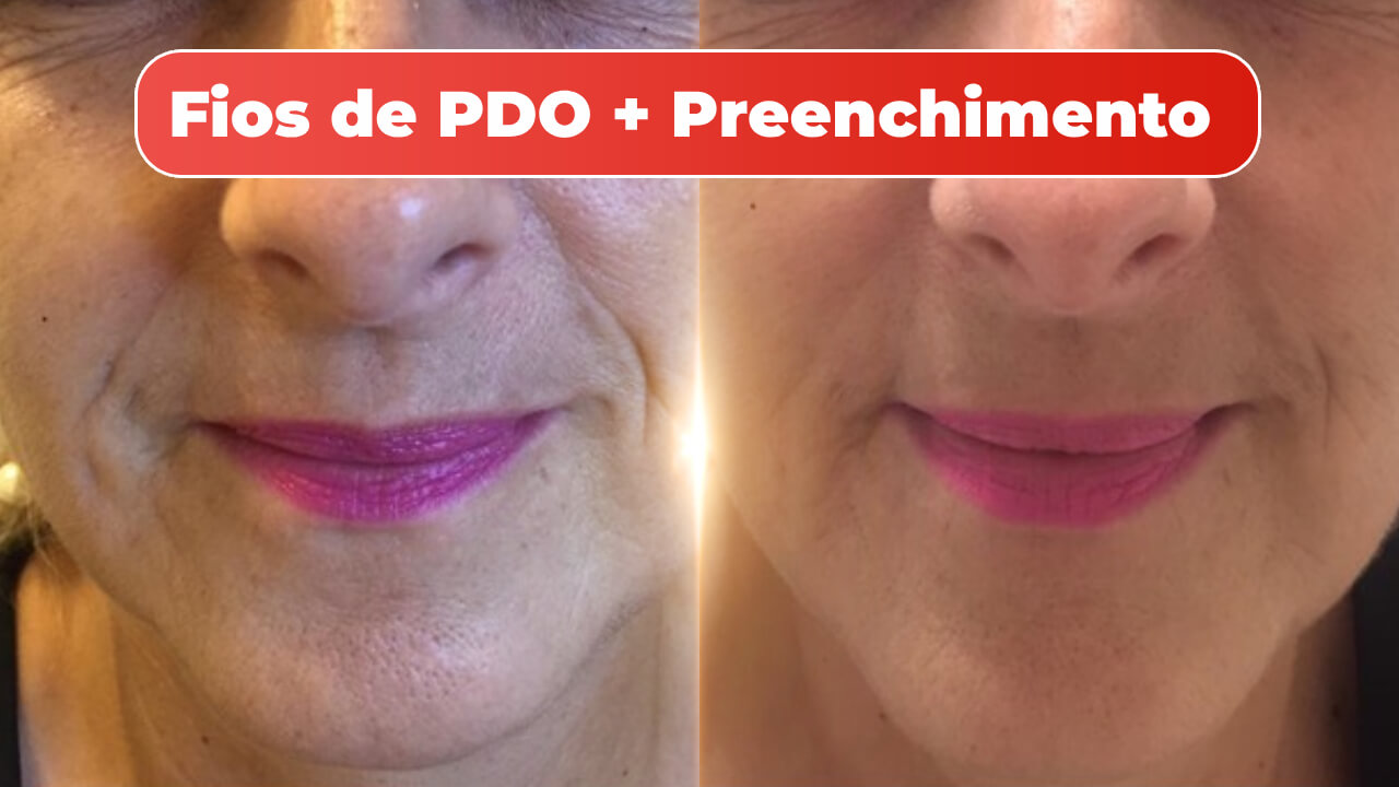 fios-de-pdo-mitras-estetica-1.jpg