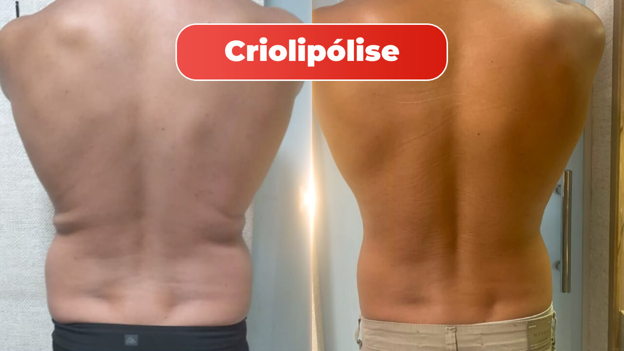 mitras-estetica-criolipolise-1.jpg
