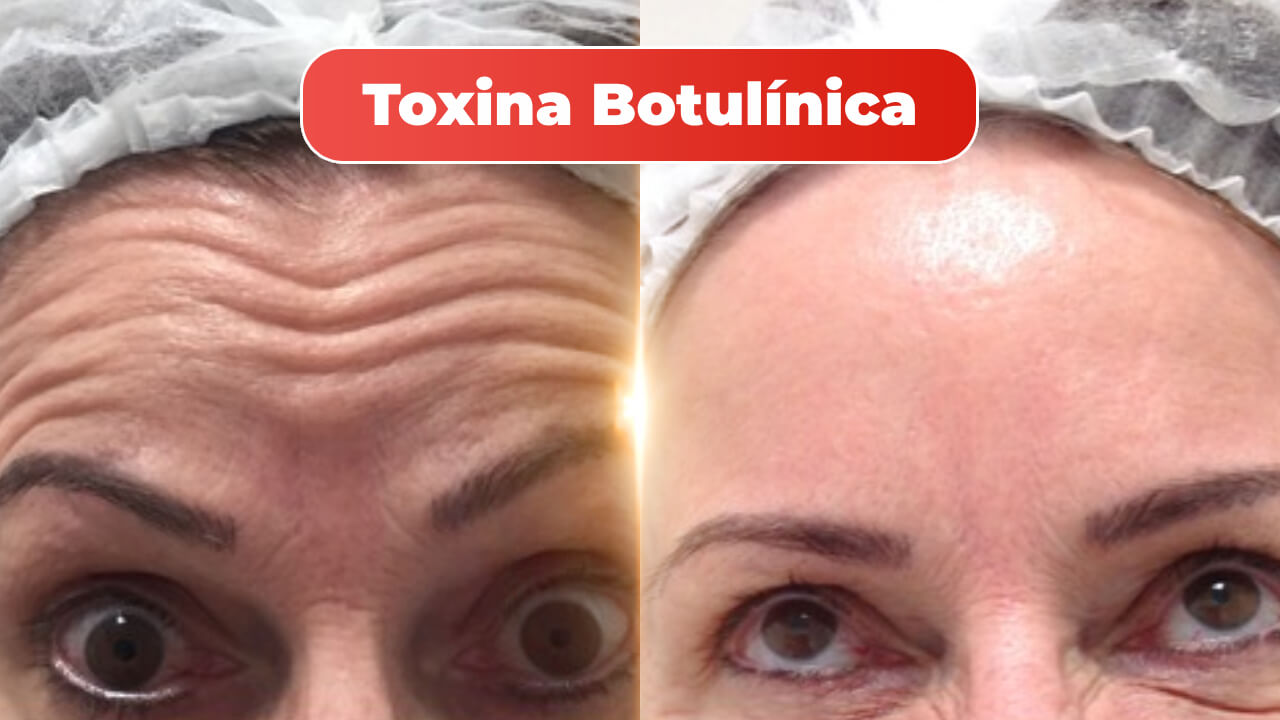 mitras-estetica-linhas-de-expressao-2.jpg
