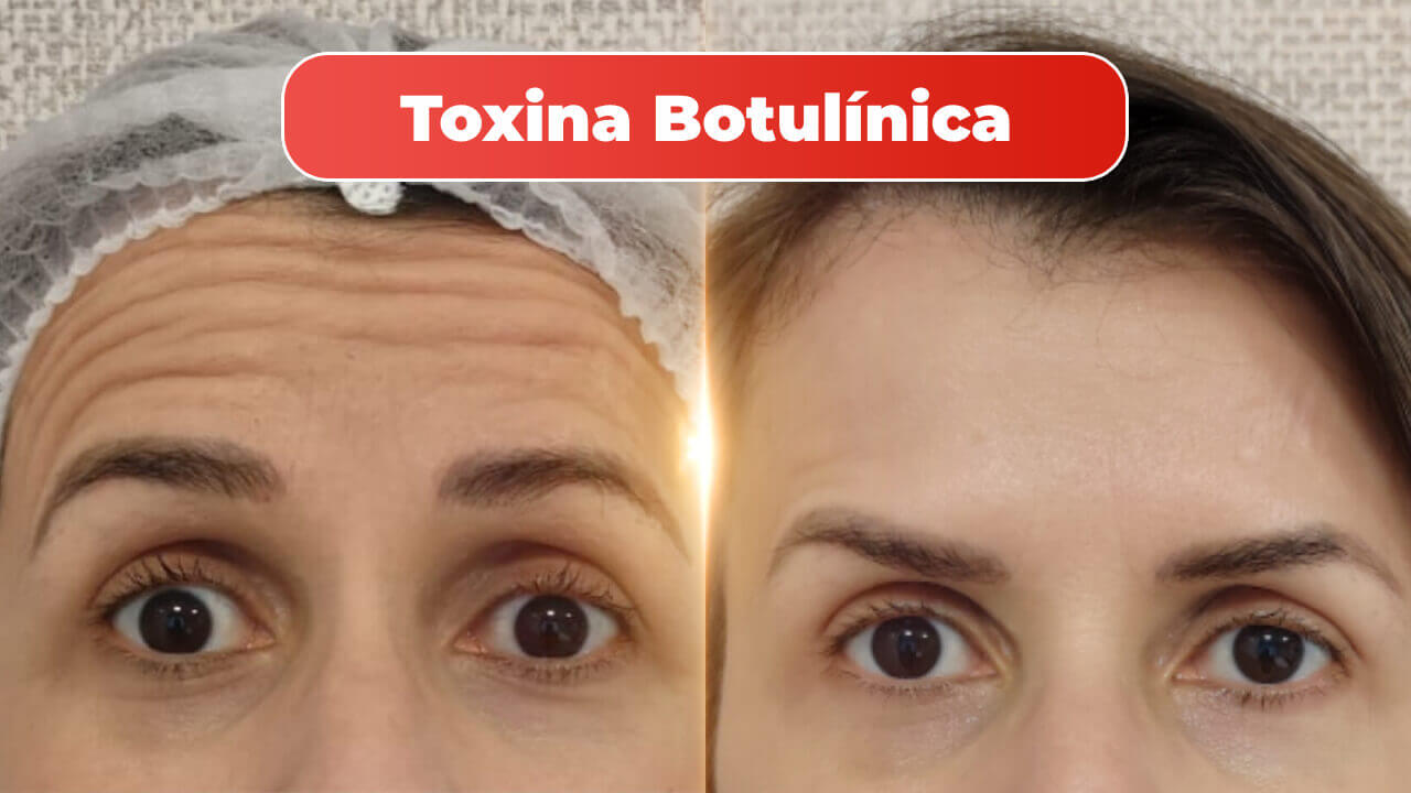 mitras-estetica-linhas-de-expressao-na-testa-1-1.jpg