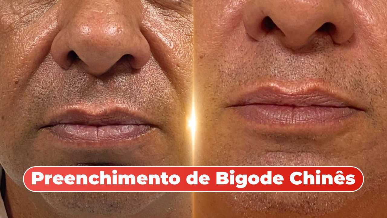 preenchimento de bigode chines mitras antes e depois
