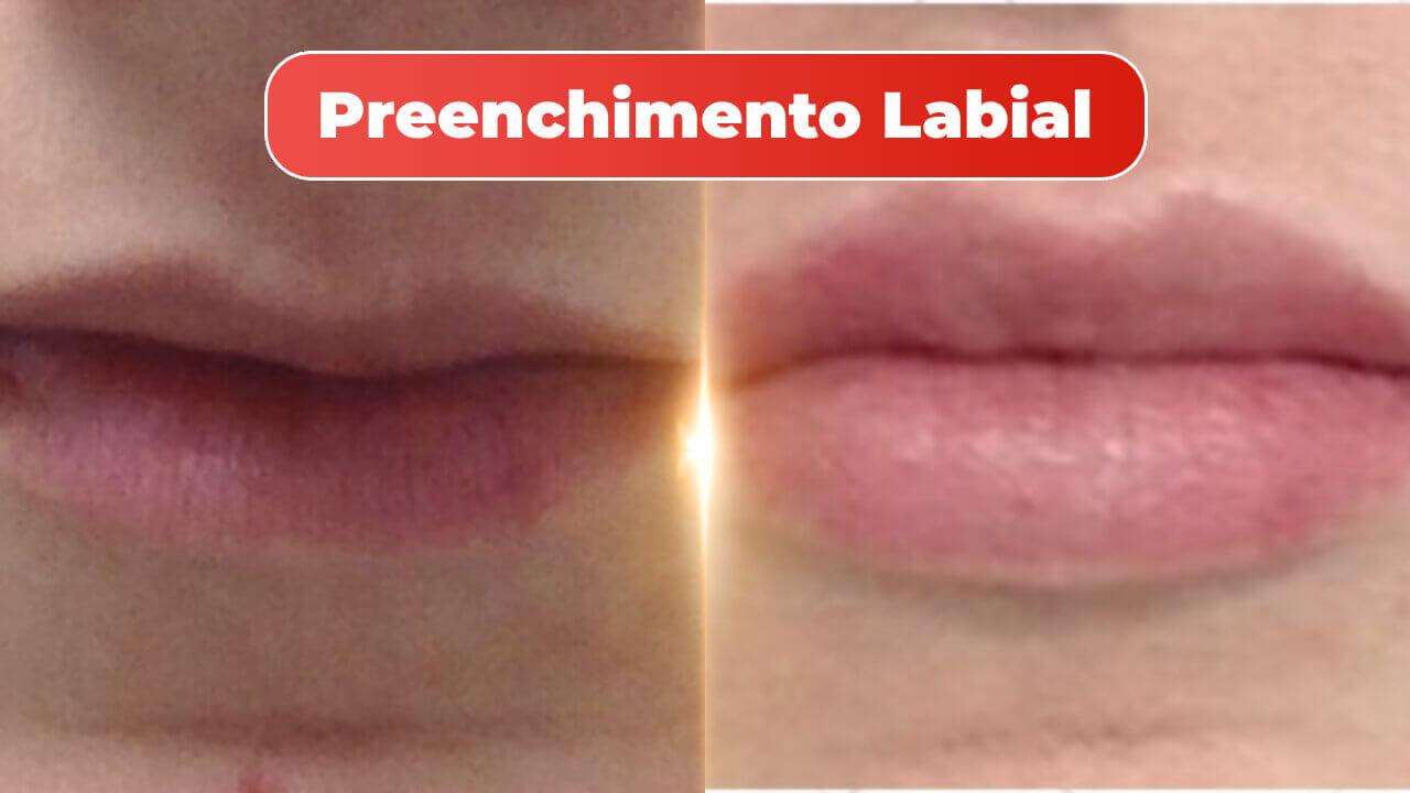 preenchimento-labial-1-1.jpg