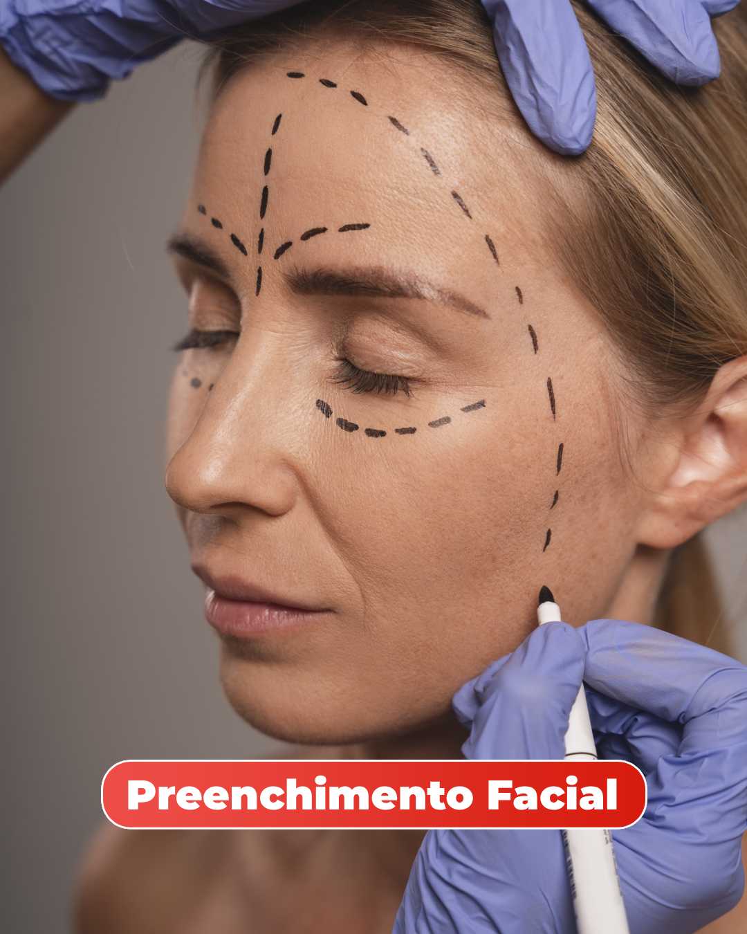 preenchimento facial na mitras estética